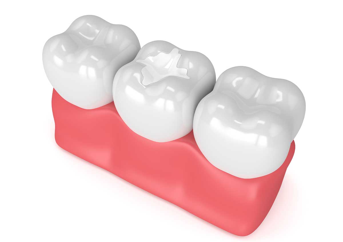 Keep Decay from Ruining Your Adult Teeth with Dental Sealants