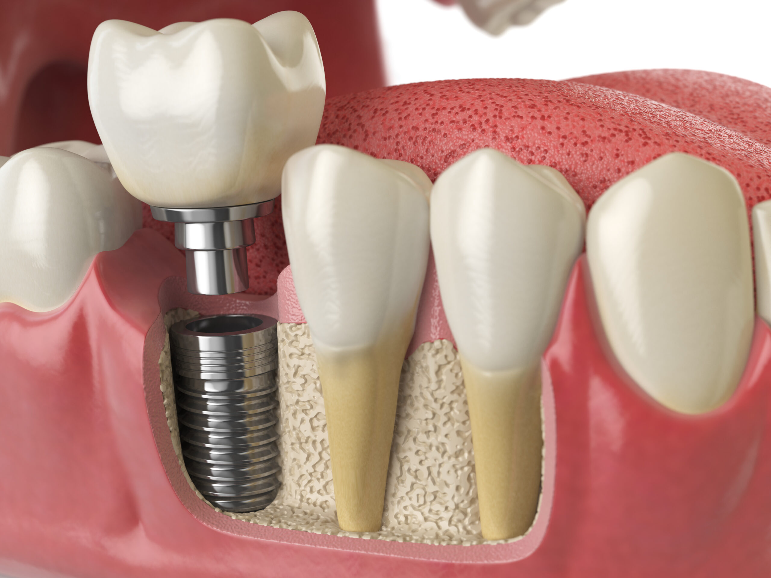 dental implants Charlottesville